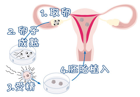 取卵手术室